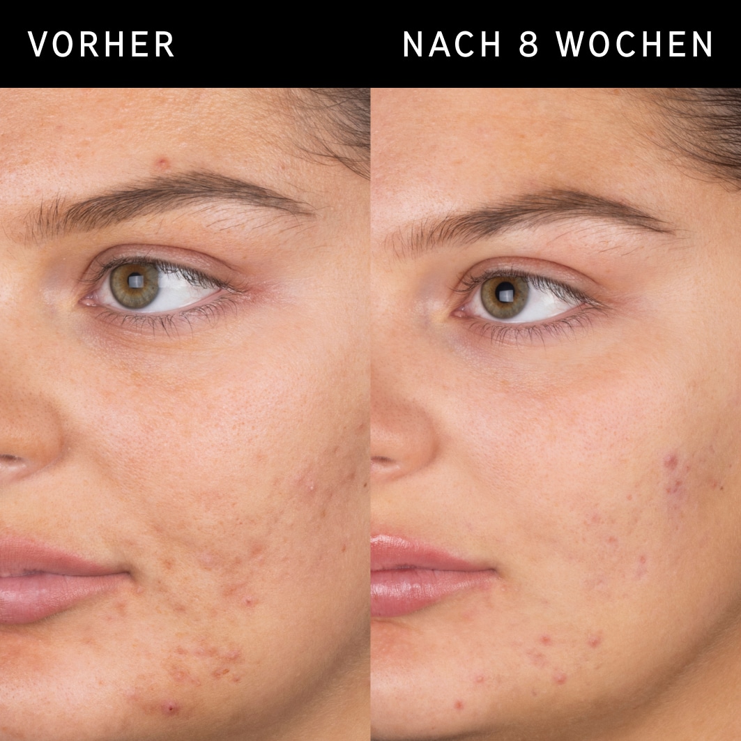 Salicylic Acid Cleanser