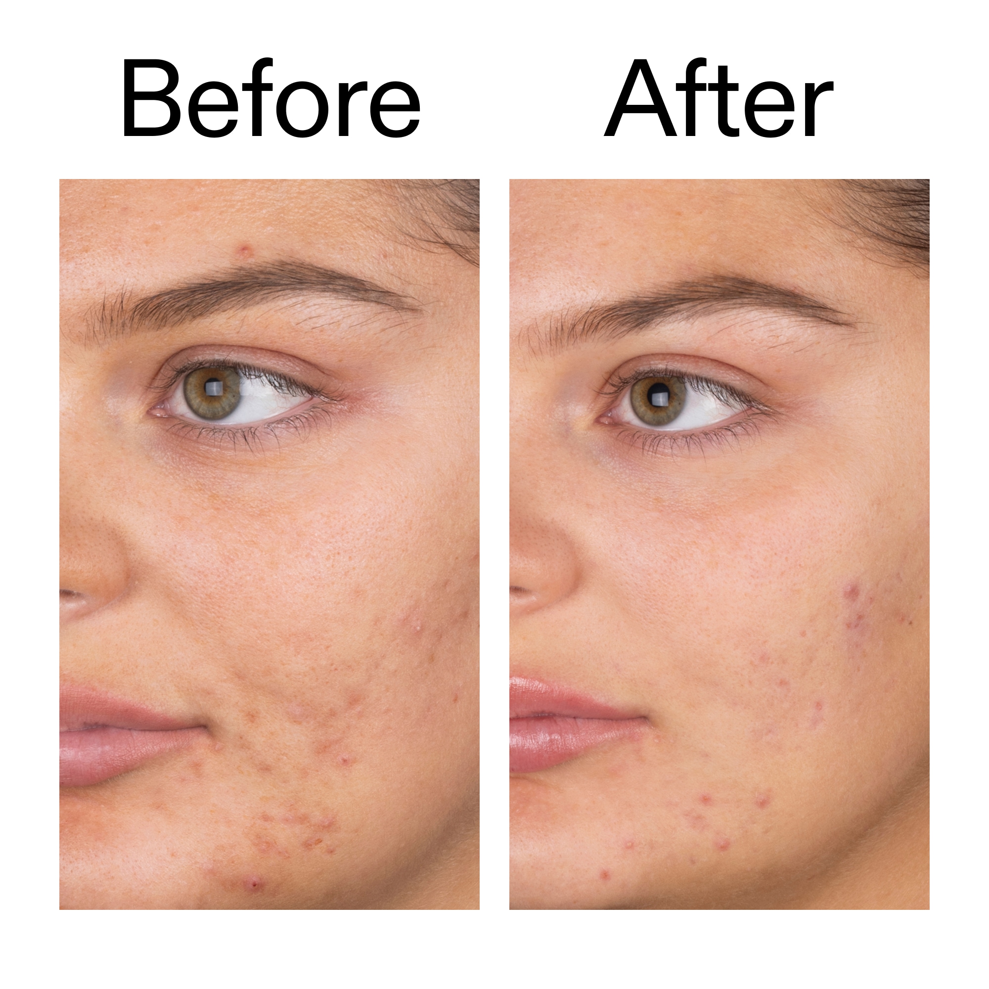 Salicylic Acid Cleanser