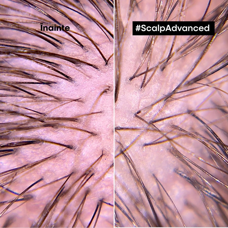 Scalp Advanced, cu Niacinamide Tratament