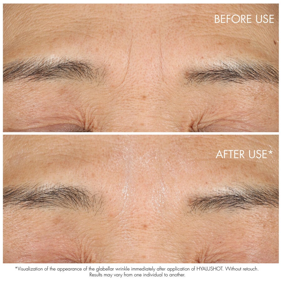 Capture Totale Hyalushot