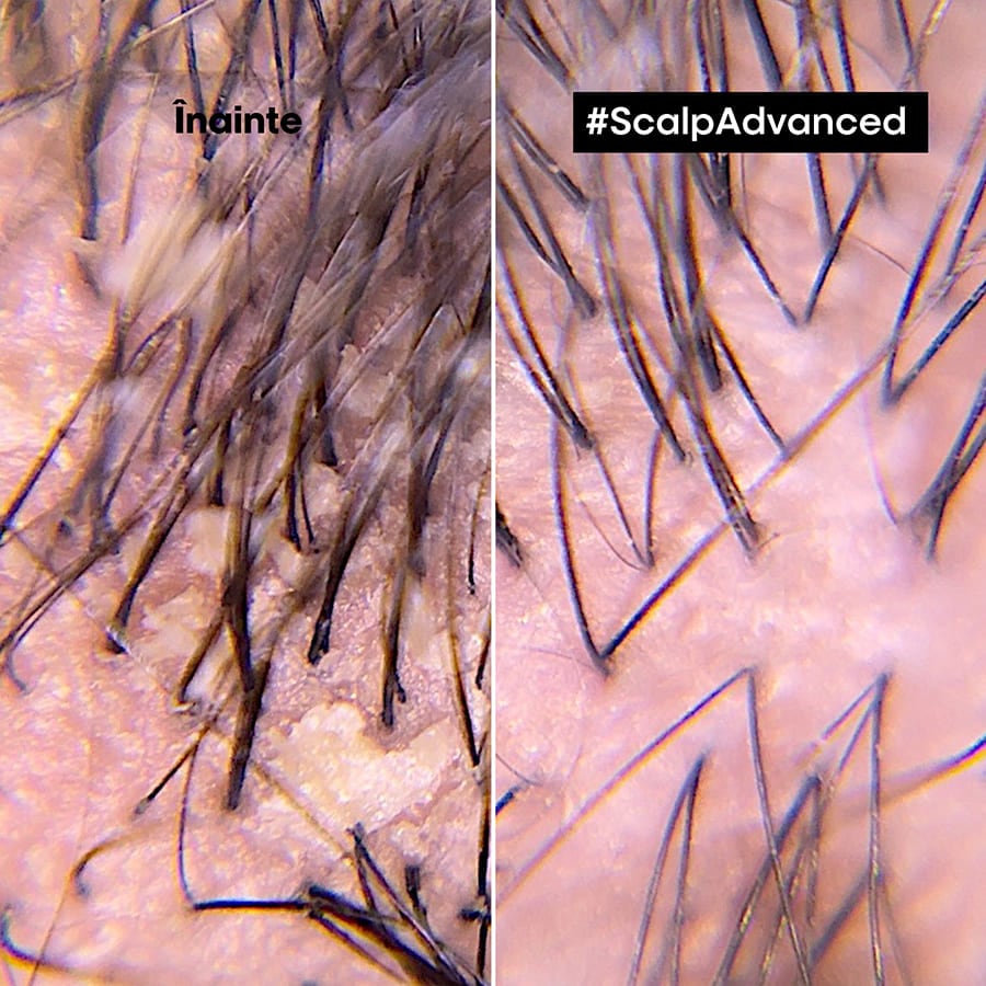 Scalp Advanced Shampooing Professionel with Pirocton Olamina